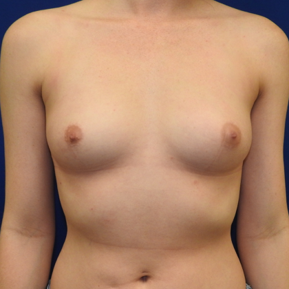 Before Breast Augmentation in Nashville with Dr. Paul Papillion
