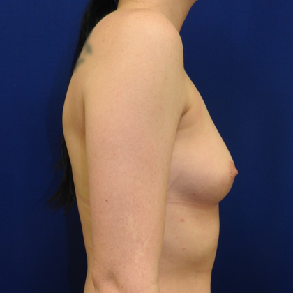 Breast Augmentation