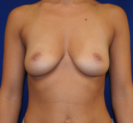 Breast Augmentation