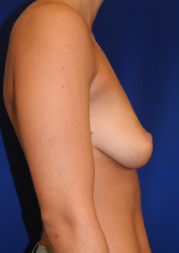 Breast Augmentation