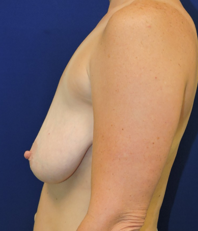 Breast Augmentation With Lift