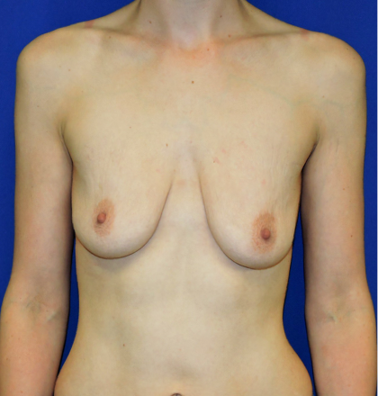 Breast Augmentation With Lift