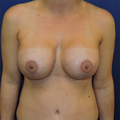 Breast Augmentation With Lift