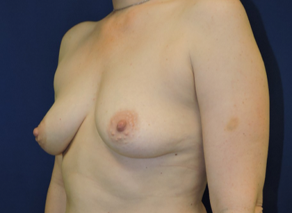 Breast Augmentation With Lift Case 409 Before Photo Breast Augmentation With Lift