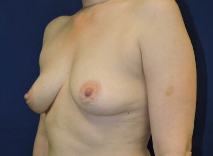 Breast Augmentation With Lift