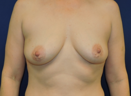Breast Augmentation With Lift Case 409 Before Photo Breast Augmentation With Lift