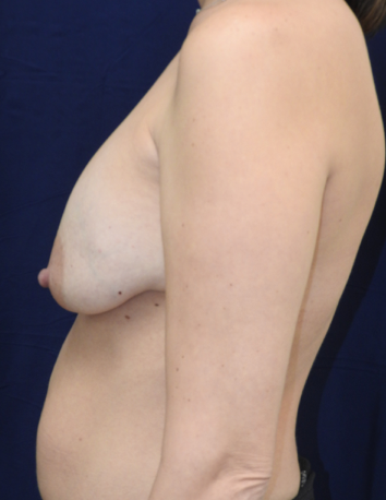 Breast Implant Revision