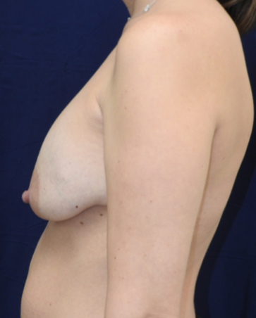 Breast Implant Revision