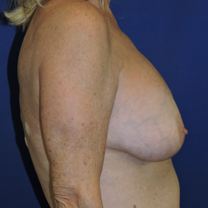 Breast Implant Removal