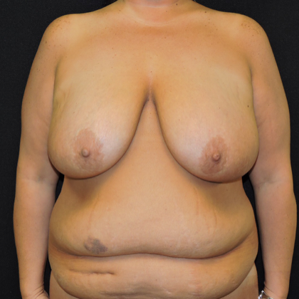 Breast Reduction