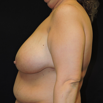 Breast Reduction