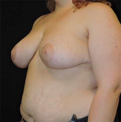 Breast Reduction