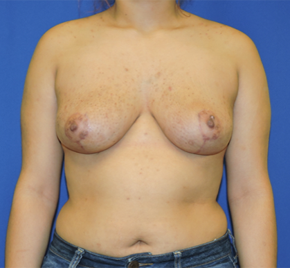 Breast Reduction