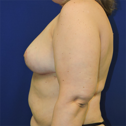 Breast Reduction