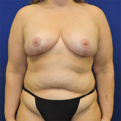 Breast Reduction