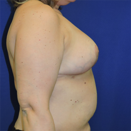 Breast Reduction