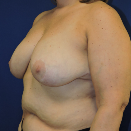 Breast Reduction