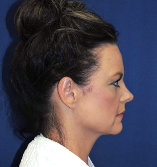 Rhinoplasty