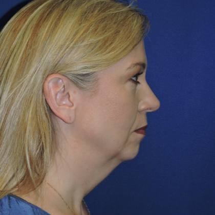 Chin Augmentation Before & After Photos