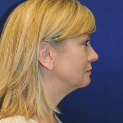 Chin Augmentation