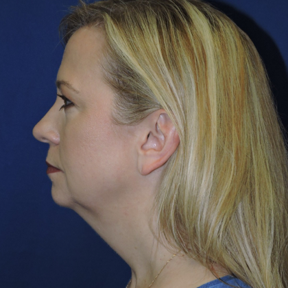 Chin Augmentation