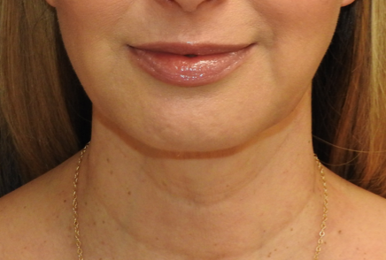 Chin Augmentation