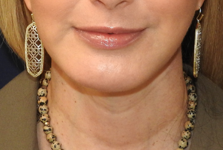 Chin Augmentation