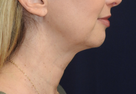 Chin Augmentation