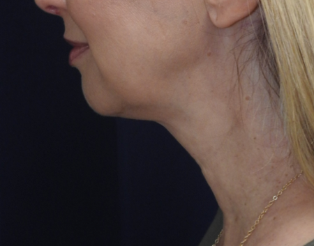 Chin Augmentation