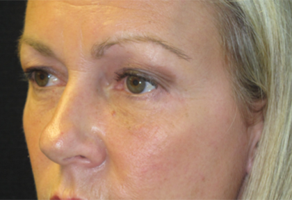 Eyelid Surgery