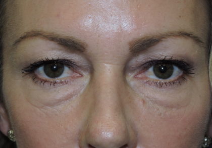 Eyelid Surgery