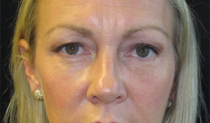 Eyelid Surgery