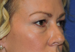 Eyelid Surgery