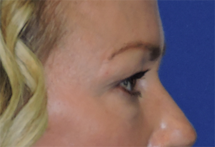 Eyelid Surgery