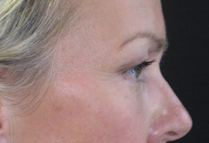 Eyelid Surgery