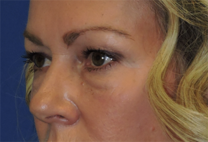 Eyelid Surgery