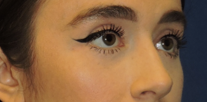 Eyelid Surgery