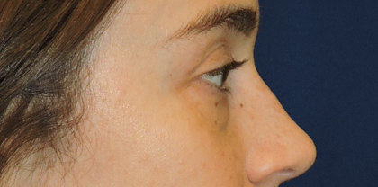 Eyelid Surgery