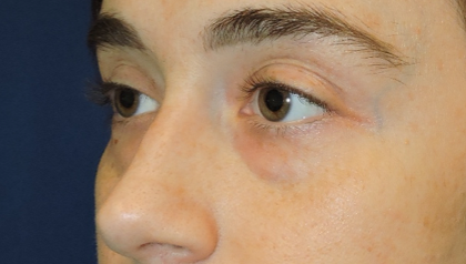 Eyelid Surgery