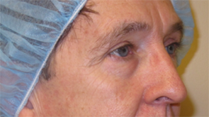 Eyelid Surgery