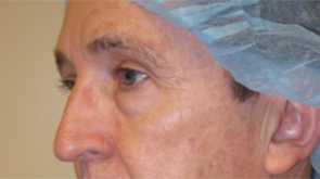 Eyelid Surgery