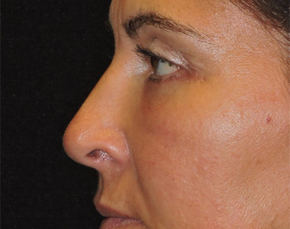 Eyelid Surgery