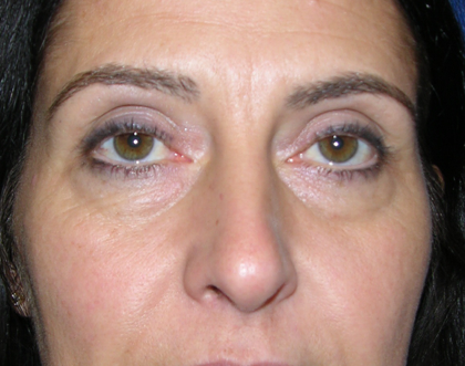 Eyelid Surgery