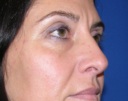 Eyelid Surgery