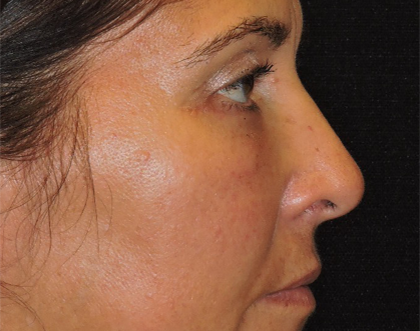 Eyelid Surgery