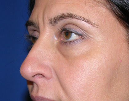 Eyelid Surgery