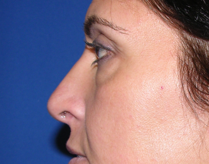 Eyelid Surgery