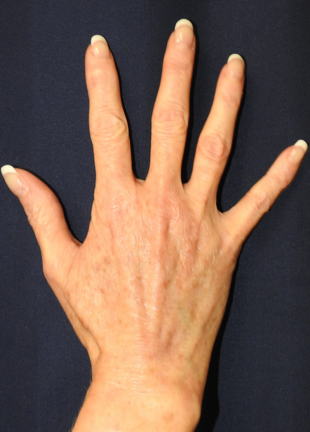 Hand Rejuvenation