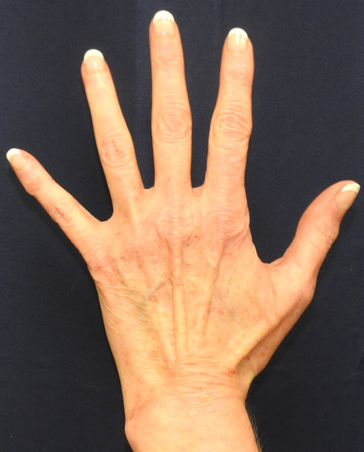 Hand Rejuvenation