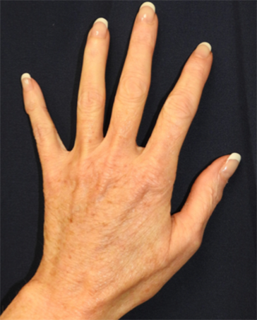 Hand Rejuvenation